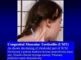 TORTICOLLIS/Wry Neck/Krcz szyi/LECTURE in Hungary