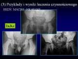 DDH/Cong.luxation of hip/LUBLIN method ot therapy/LECTURE