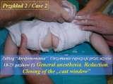 DDH/Cong.luxation of hip/LUBLIN method ot therapy/LECTURE