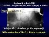 DDH/Cong.luxation of hip/LUBLIN method ot therapy/LECTURE
