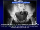 Biodra bolesne/Imperfect hips/Ureife Huften/LECTURE