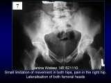 Wody geotermalne w ortopedii. Geothermal water in orthopaedic therapy.