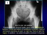 Wody geotermalne w ortopedii. Geothermal water in orthopaedic therapy.