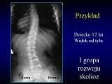 Wody geotermalne w ortopedii. Geothermal water in orthopaedic therapy.
