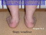 Test fleksyjny palc�w stopy / Flexions test of toes LECTURE