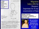 CEREBRAL PALSY, MPDZ / Mozgowe porazenie dziec. IZP. LECTURE