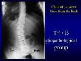 Presentation of biomechanical etiology of so-called idiopathic scoliosis on 58 Orthopaedic Congress in Cairo/Egypt, 4th -9th December 2006.