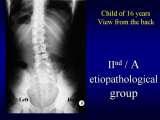Presentation of biomechanical etiology of so-called idiopathic scoliosis on 58 Orthopaedic Congress in Cairo/Egypt, 4th -9th December 2006.