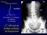 Presentation of biomechanical etiology of so-called idiopathic scoliosis on 58 Orthopaedic Congress in Cairo/Egypt, 4th -9th December 2006.