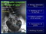 Presentation of biomechanical etiology of so-called idiopathic scoliosis on 58 Orthopaedic Congress in Cairo/Egypt, 4th -9th December 2006.