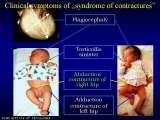 Presentation of biomechanical etiology of so-called idiopathic scoliosis on 58 Orthopaedic Congress in Cairo/Egypt, 4th -9th December 2006.