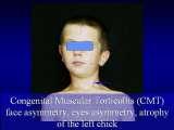 TORTICOLLIS/Wry Neck/Kręcz szyi/LECTURE in Hungary