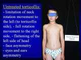 TORTICOLLIS/Wry Neck/Krcz szyi/LECTURE in Hungary
