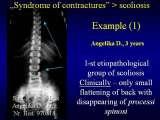 SYNDROME of CONTRACTURES-Hip Dysplasia / DDH / WryNeck/M.Blount/SCOL./LECTURES