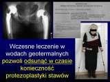 Wody geotermalne w ortopedii. Geothermal water in orthopaedic therapy.