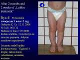 BLOUNT DISEASE/Golenie szpotawe/LECTURE/Knee Valgus Deformity/Prague/19.10.07