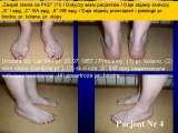 Test fleksyjny palców stopy / Flexions test of toes LECTURE