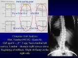 Presentation of biomechanical etiology of so-called idiopathic scoliosis on 58 Orthopaedic Congress in Cairo/Egypt, 4th -9th December 2006. Patient - Kasia - examination on 28th April 2007 - no progress of curves, but slight gibbous costalis persist. The adduction of the right hip: 5 degree in extension of the knee and 0 degree by flexion of the knee. Big danger for progression of scoliosis. The child need urgently streching exercises - removing of the contracture of the right hip. 